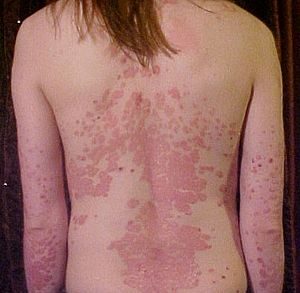 300px-psoriasis_on_back1