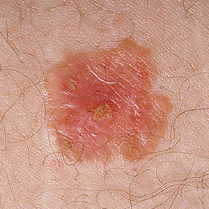 varigos-images-skin-cancer2